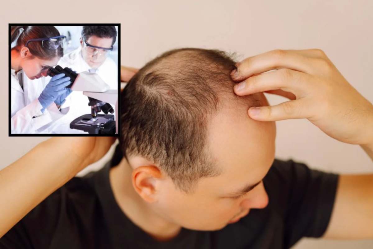 Studi su alopecia